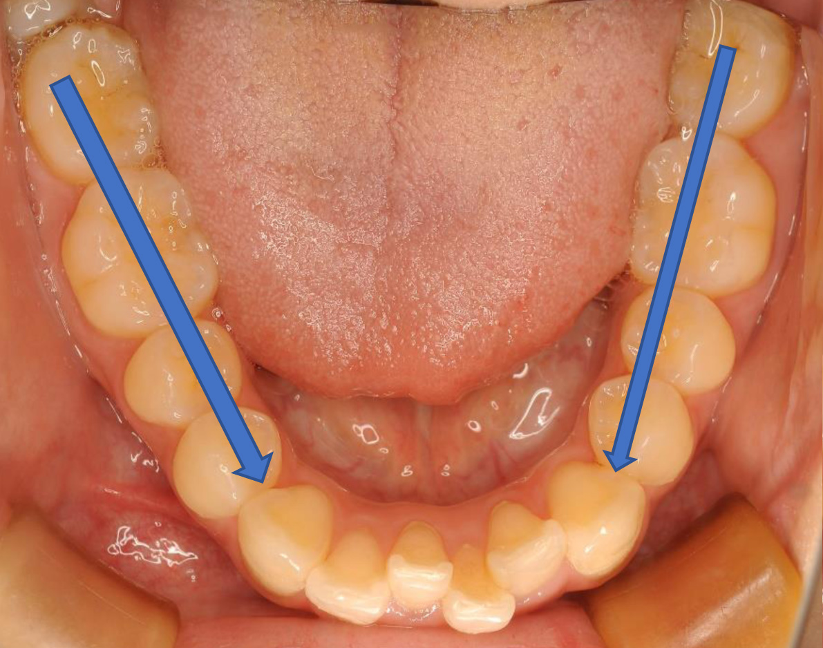 生理的な歯の移動-1
