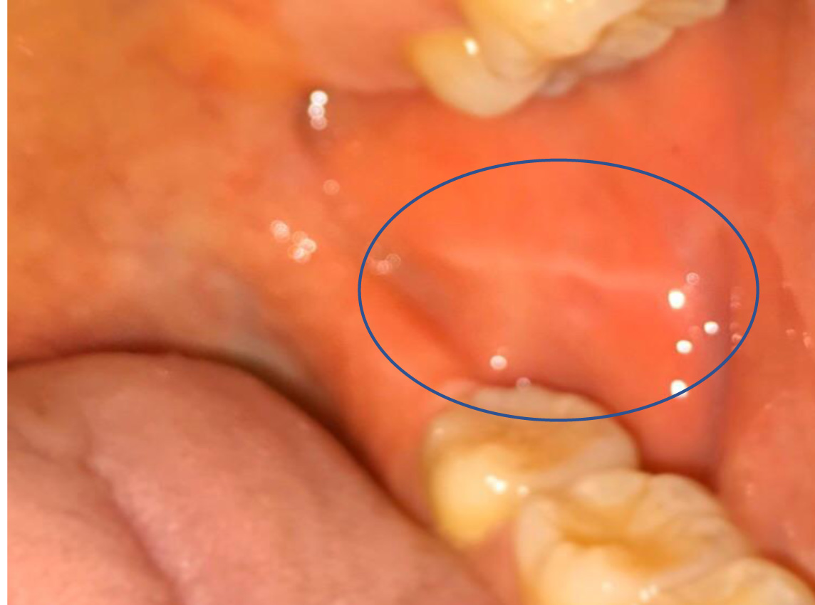 頬粘膜がんの原因は何ですか?